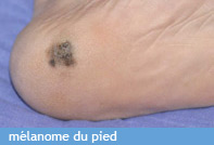 melanome-du-pied2