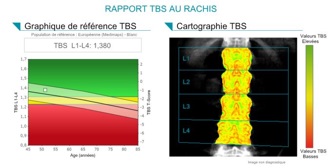 TBS