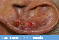 carcinome_epidermoide