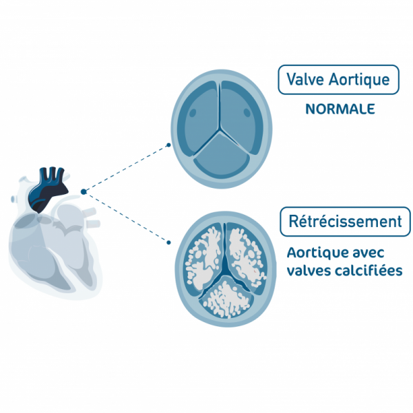 Valve aortique Valve aortique