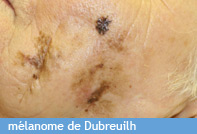 melanome-de-Dubreuilh