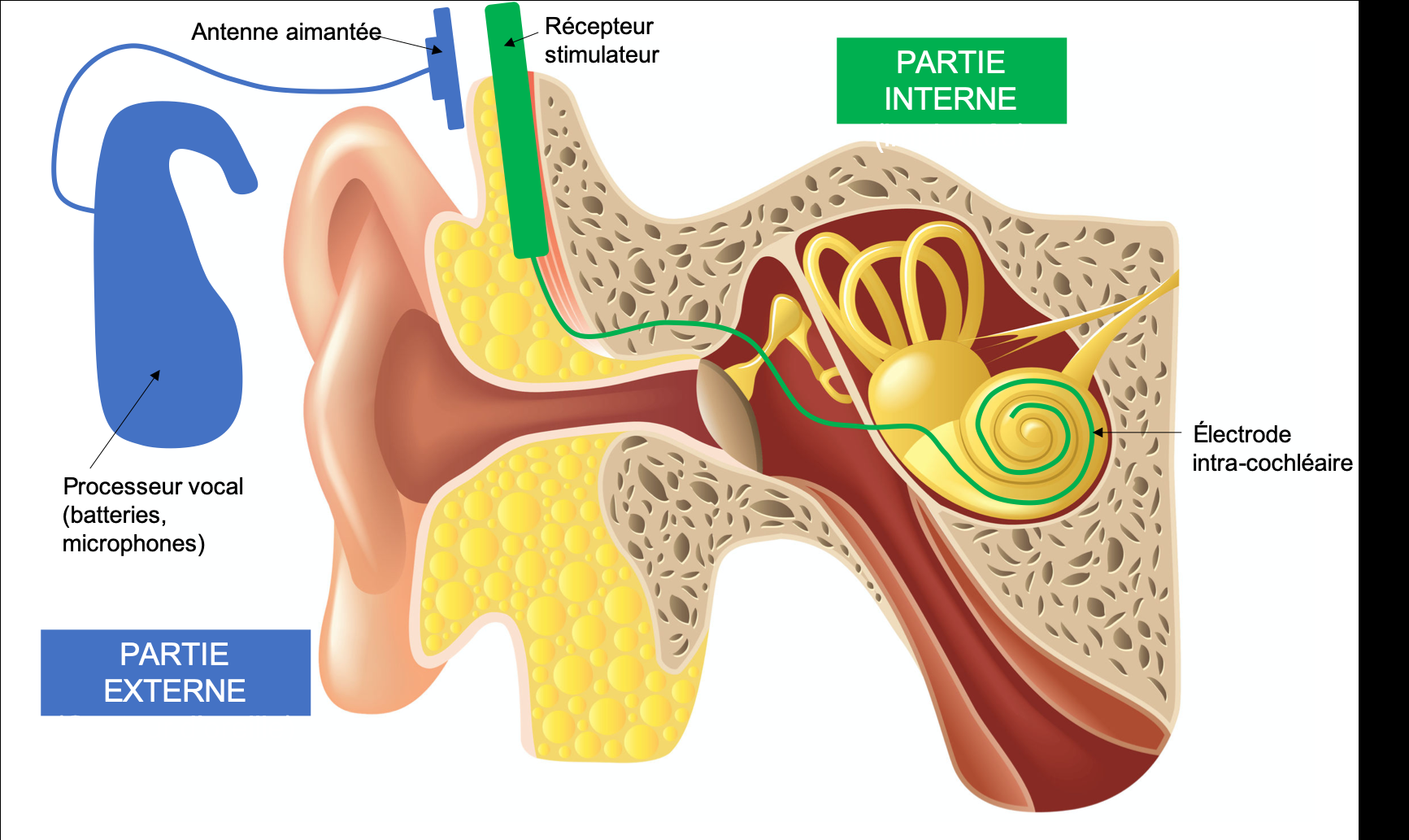 Surdité profonde : les implants cochléaires