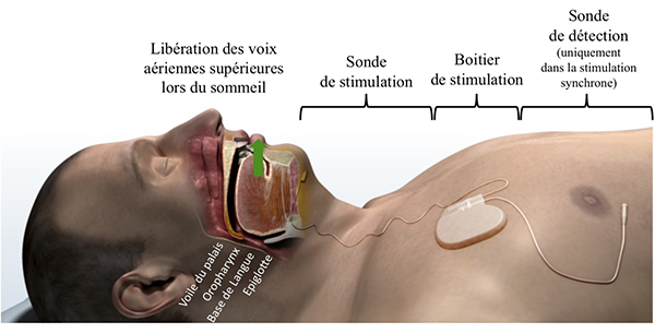 SAOS Stimulateur Inspire SAOS Stimulateur Inspire