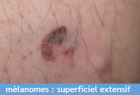 melanome-superficiel