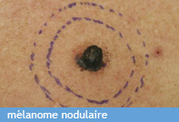 Le M lanome CHU De Bordeaux