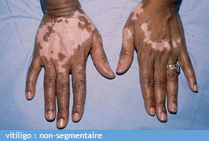 vitiligo_chu_bordeaux