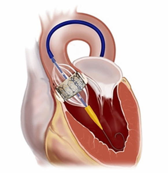 KEPHALIOS annonce une première implantation de Kalios, son dispositif  innovant de réparation de la valve mitrale