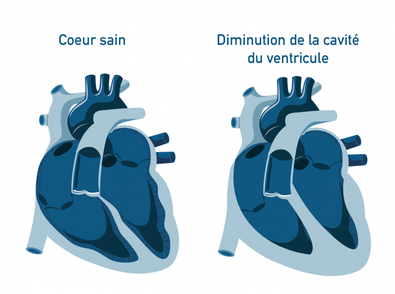 Diminution cavité cardiaque Diminution cavité cardiaque