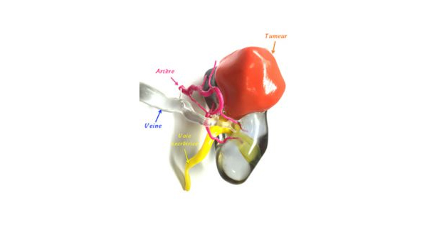 impression3D_cancer_rein_chu_bordeaux