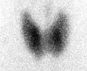 Thyroïde normale Thyroide normale
