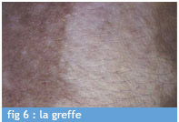 greffe_fig_6_chu_bordeaux