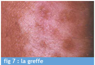 greffe_fig_7_chu_bordeaux