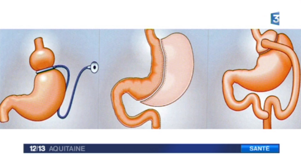 obesite schema