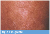 greffe_fig_8_chu_bordeaux