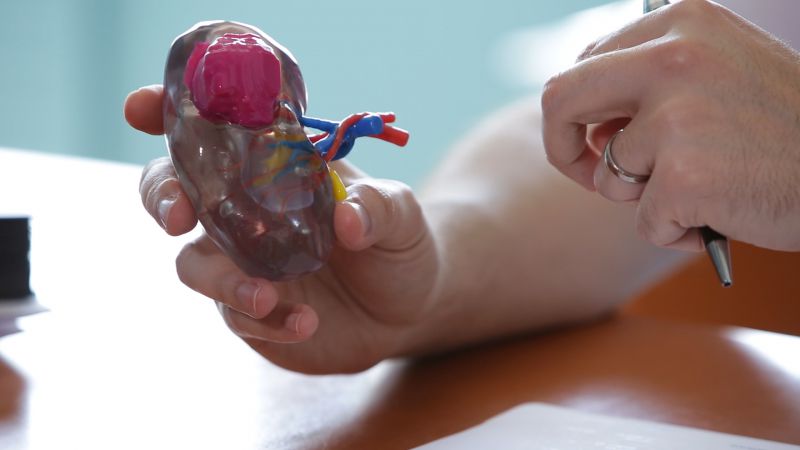cancer du rein, chirurgie renale conservatrice robotique guidee par l'image, cancer, chirurgie, modelisation 3D