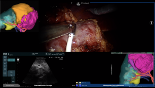chirurgie guidee par l'image chirurgie guidee par l'image, chirurgie, chirurgie rein, cancer du rein