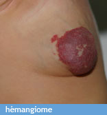 hemangiome infantile