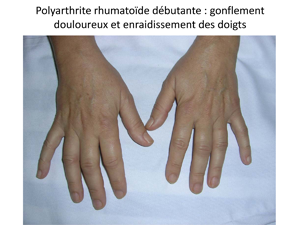 PriseEnChargePolyarthriteRhumatoideChuDeBordeaux