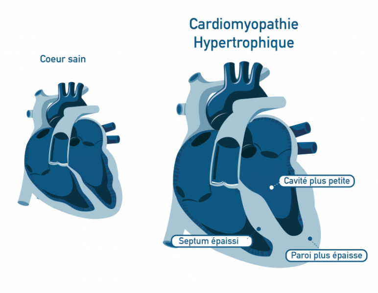 CM Hypertrophique