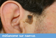 melanome-sur-naevus