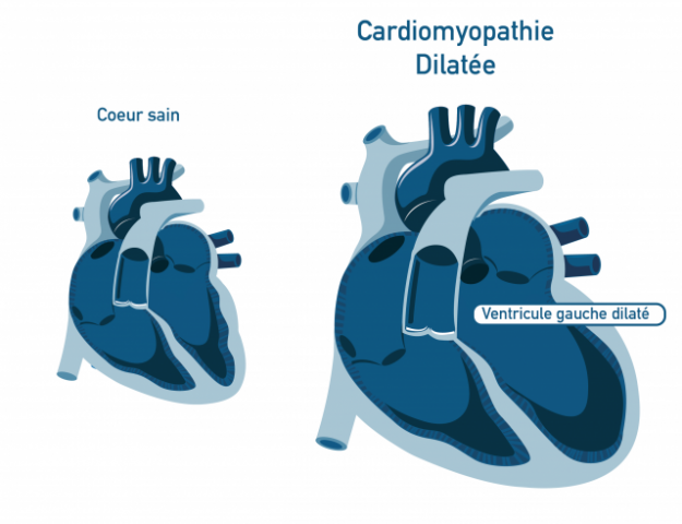 Cardiomyopathie Dilatée Cardiomyopathie Dilatée
