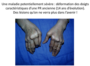 2PriseEnChargePolyarthriteRhumatoideChuDeBordeaux