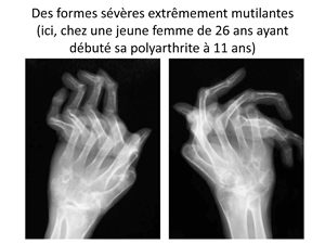 4PriseEnChargePolyarthriteRhumatoideChuDeBordeaux