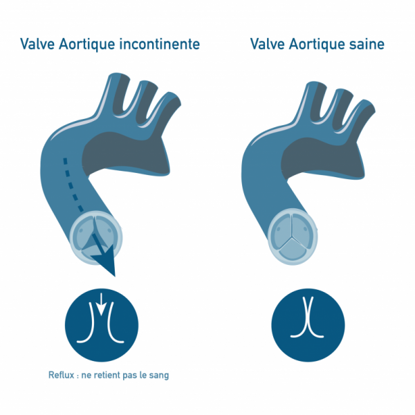 Valve aortique