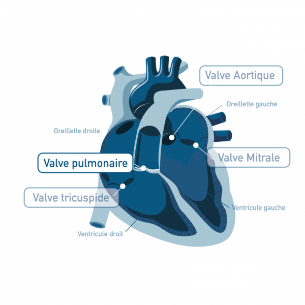 RETRECISSEMENT PULMONAIRE RETRECISSEMENT PULMONAIRE