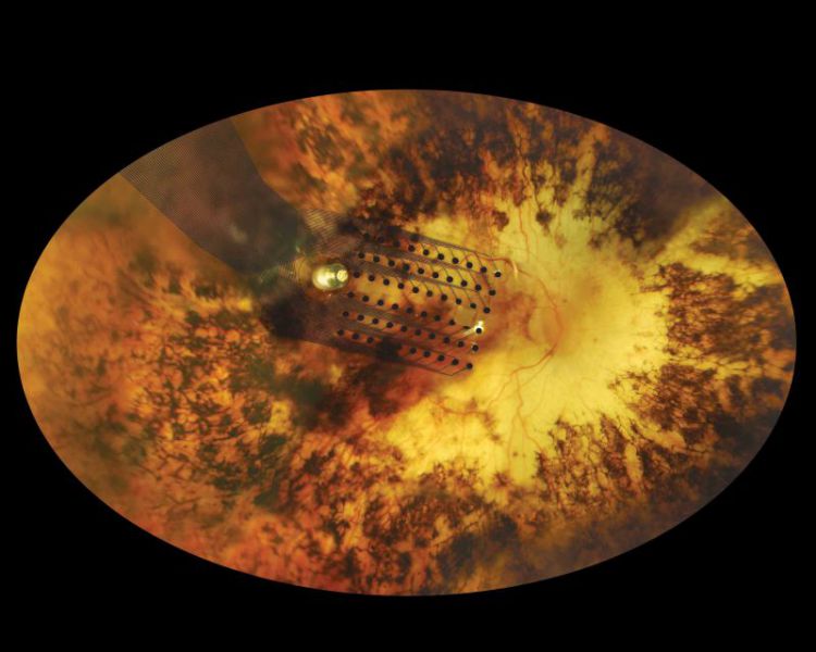 Rétine implantée Retinal implant_small