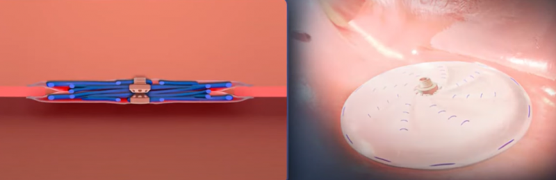 Implantation par cathétérisme cardiaque au CHU de Bordeaux
