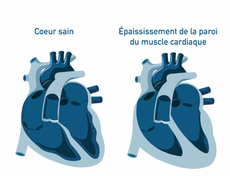 Epaississement muscle cardiaque Epaississement muscle cardiaque