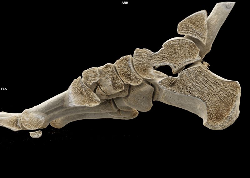 fin Os Axial Pied UHR 0,20 Br76