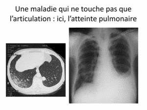 3PriseEnChargePolyarthriteRhumatoideChuDeBordeaux