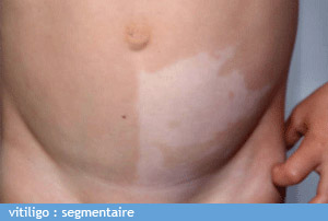 vitiligo_segmentaire_chu_bordeaux