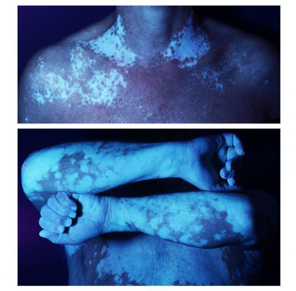 Figure 2 vitiligo non-segmentaire lumière de Wood