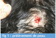 greffe_fig_1_chu_bordeaux