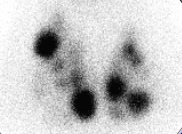 Nodules chauds Nodules chauds