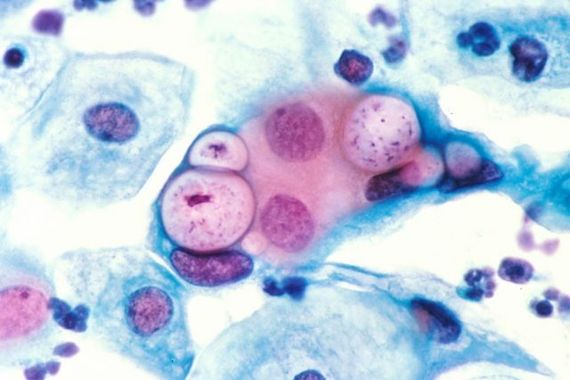 Chlamydia1-640x427