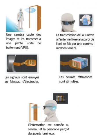Traitement cécite au CHU de Bordeaux InnovationTraitementCeciteCHUBordeaux