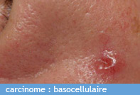 carcinome_basocellulaire