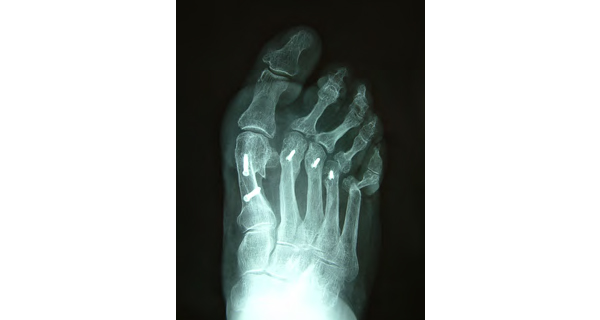 hallux_valgus