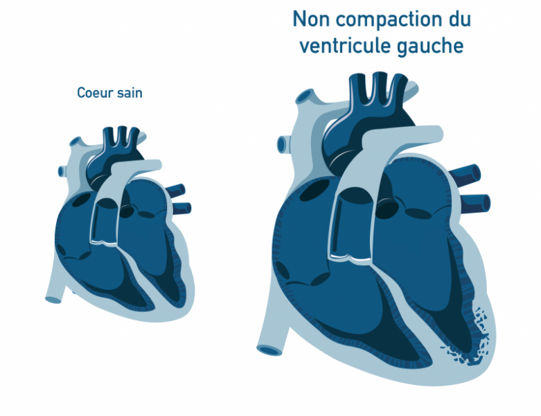 Non compaction