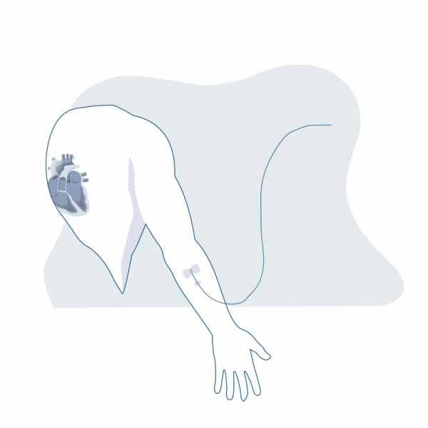 Pose de perfusion Pose de perfusion